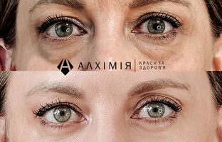 Блефаропластика, Алхімія Краси